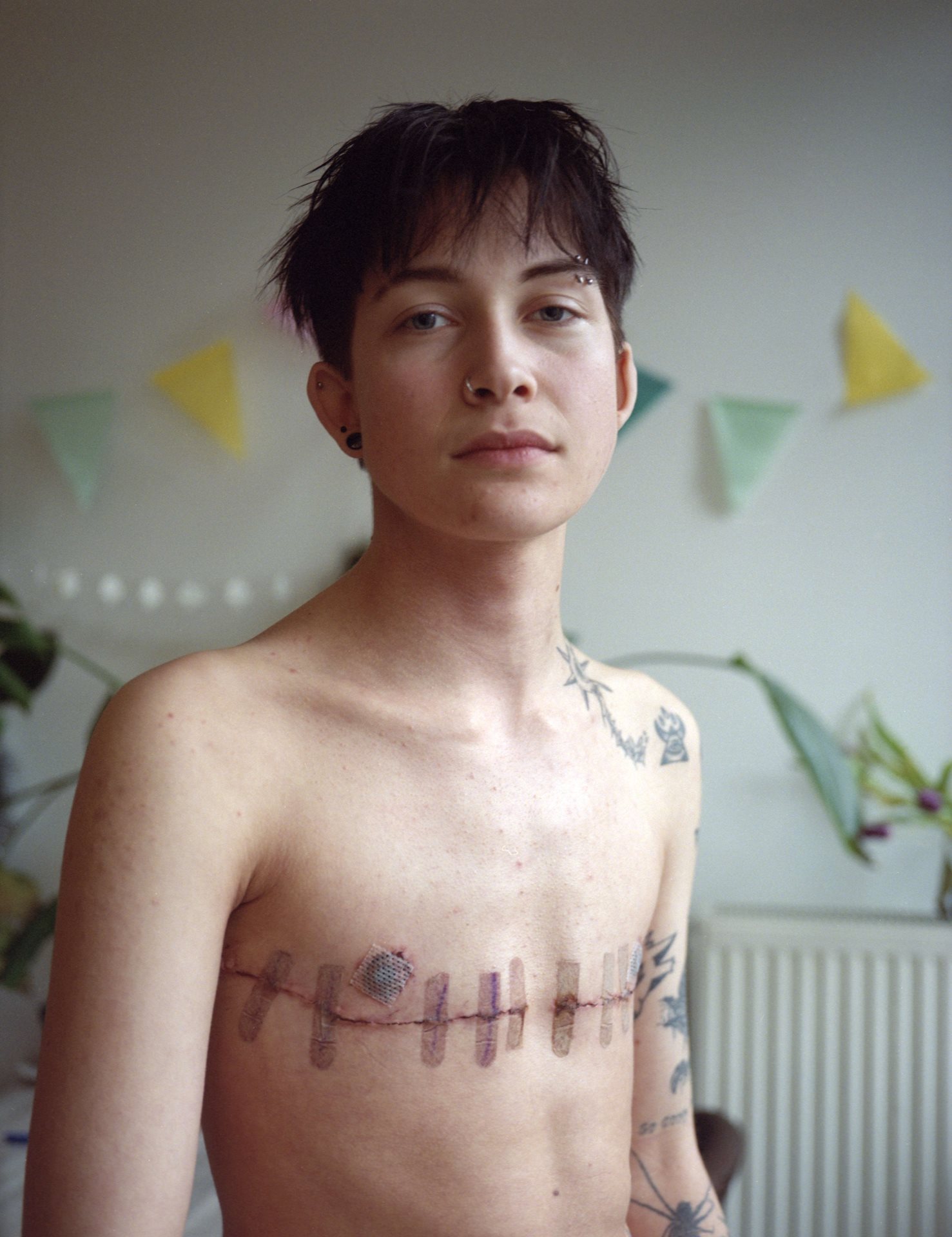 Mika (21) has been waiting for 22 months for a first consultation at a gender clinic, in Rotterdam, the Netherlands. Meanwhile, he has personally covered the costs of top surgery and hormone treatment. Mika finally had his first consultation in May 2024.&nbsp;